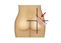 attachments-como-aplicar-injecao-intramuscular_4244-webp.21110.webp